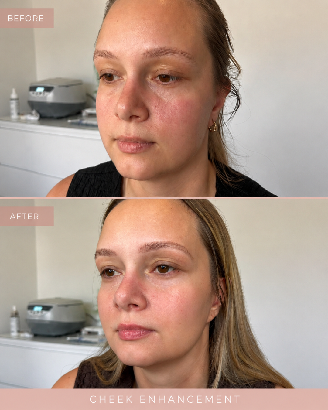 Before and after cheek enhancement