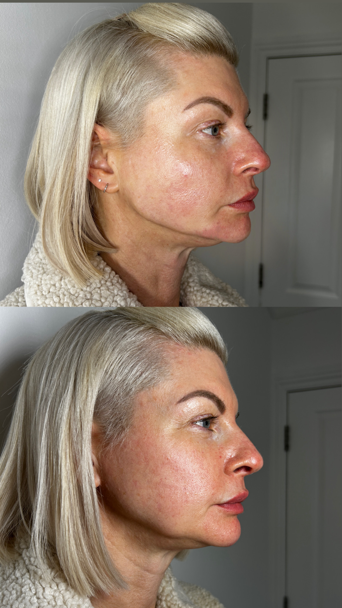 Before and after jaw filler and chin