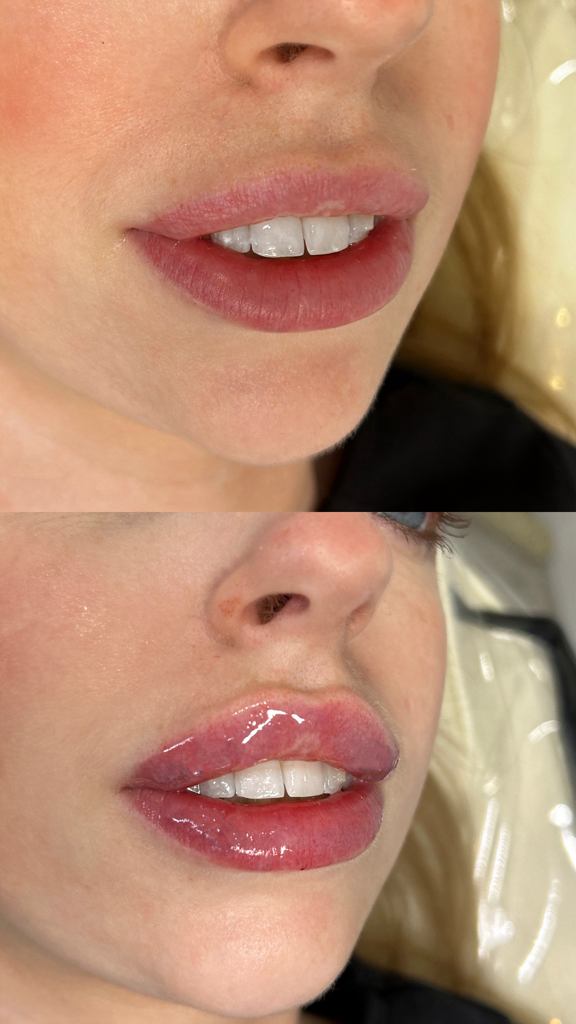 Before and after lips