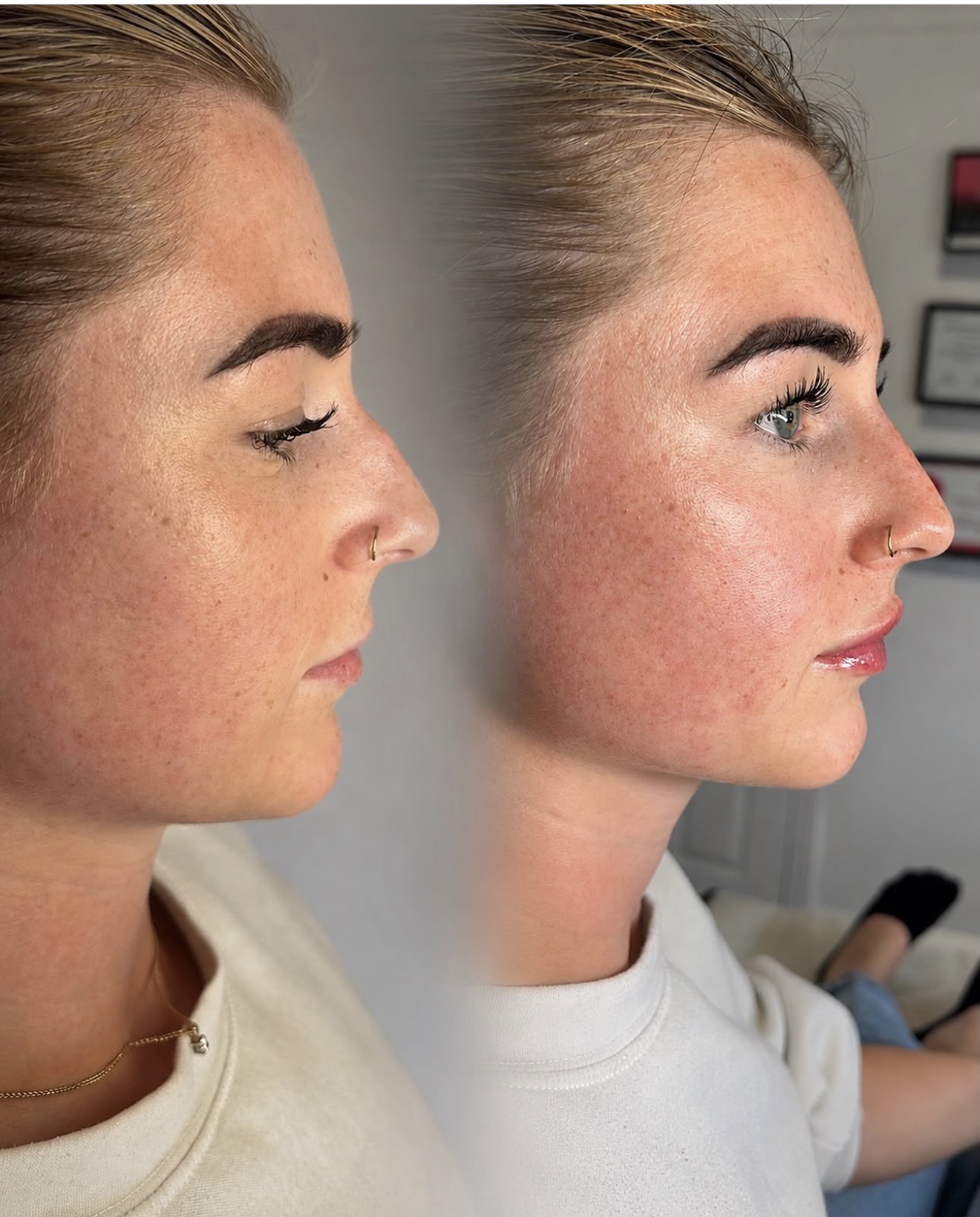 Before and after nose and lips