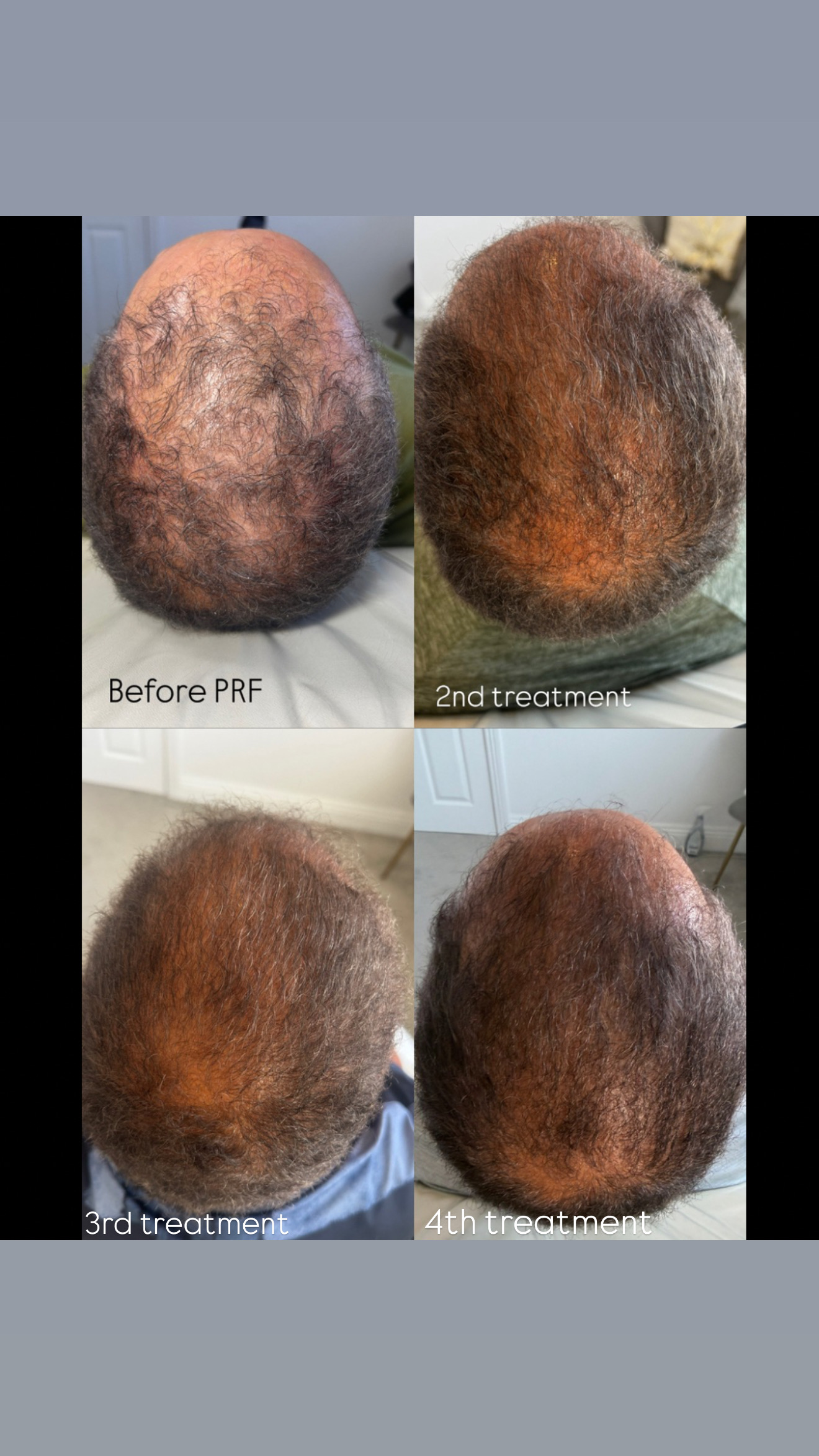 PRF hair growth from before through the fourth treatment