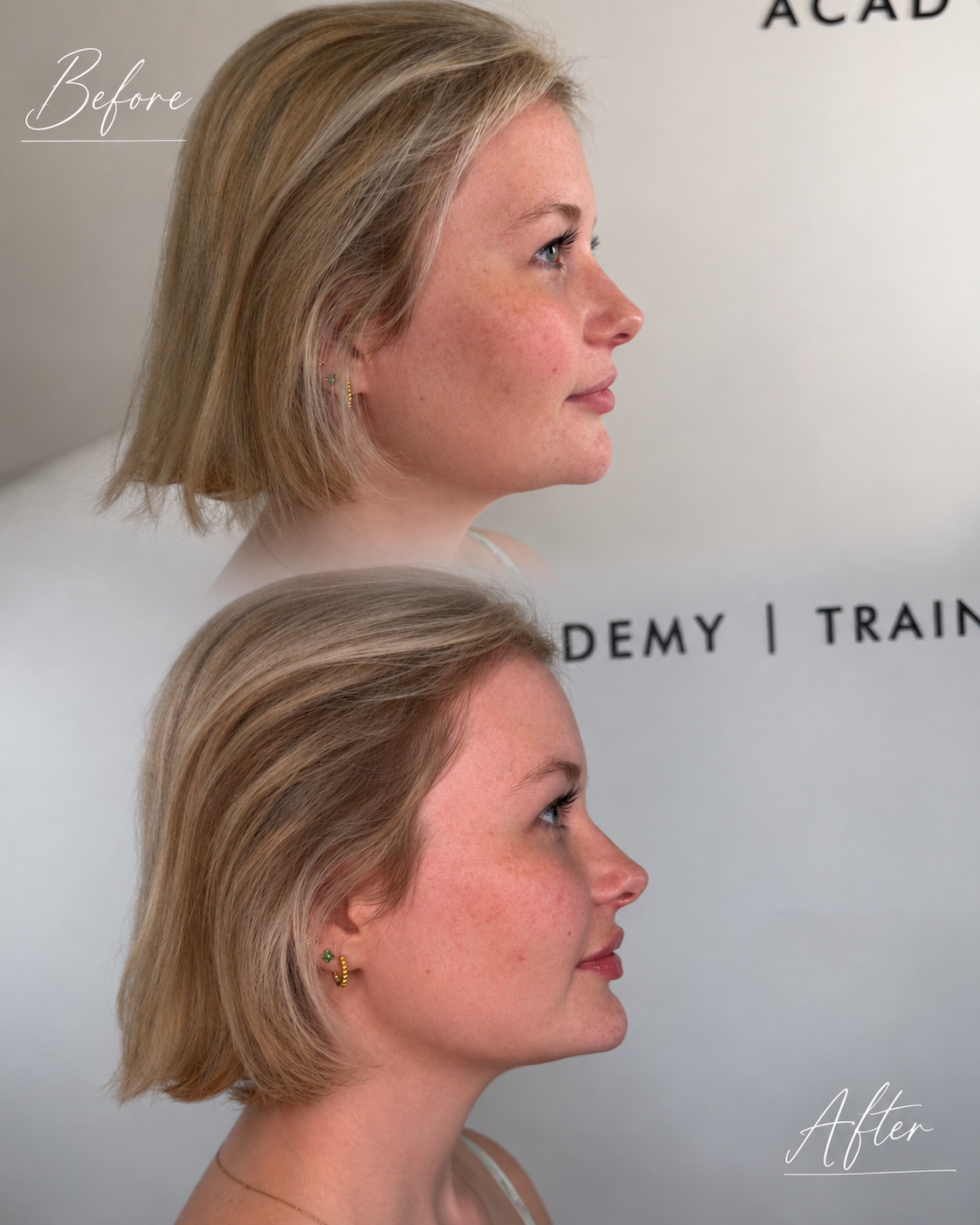 Before and after profile result