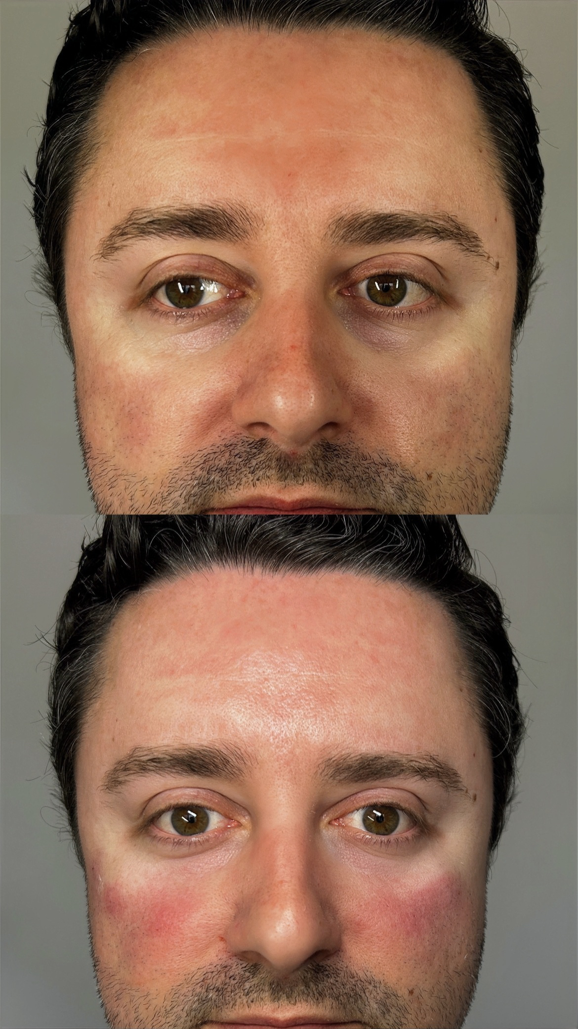 Before and after tear trough filler